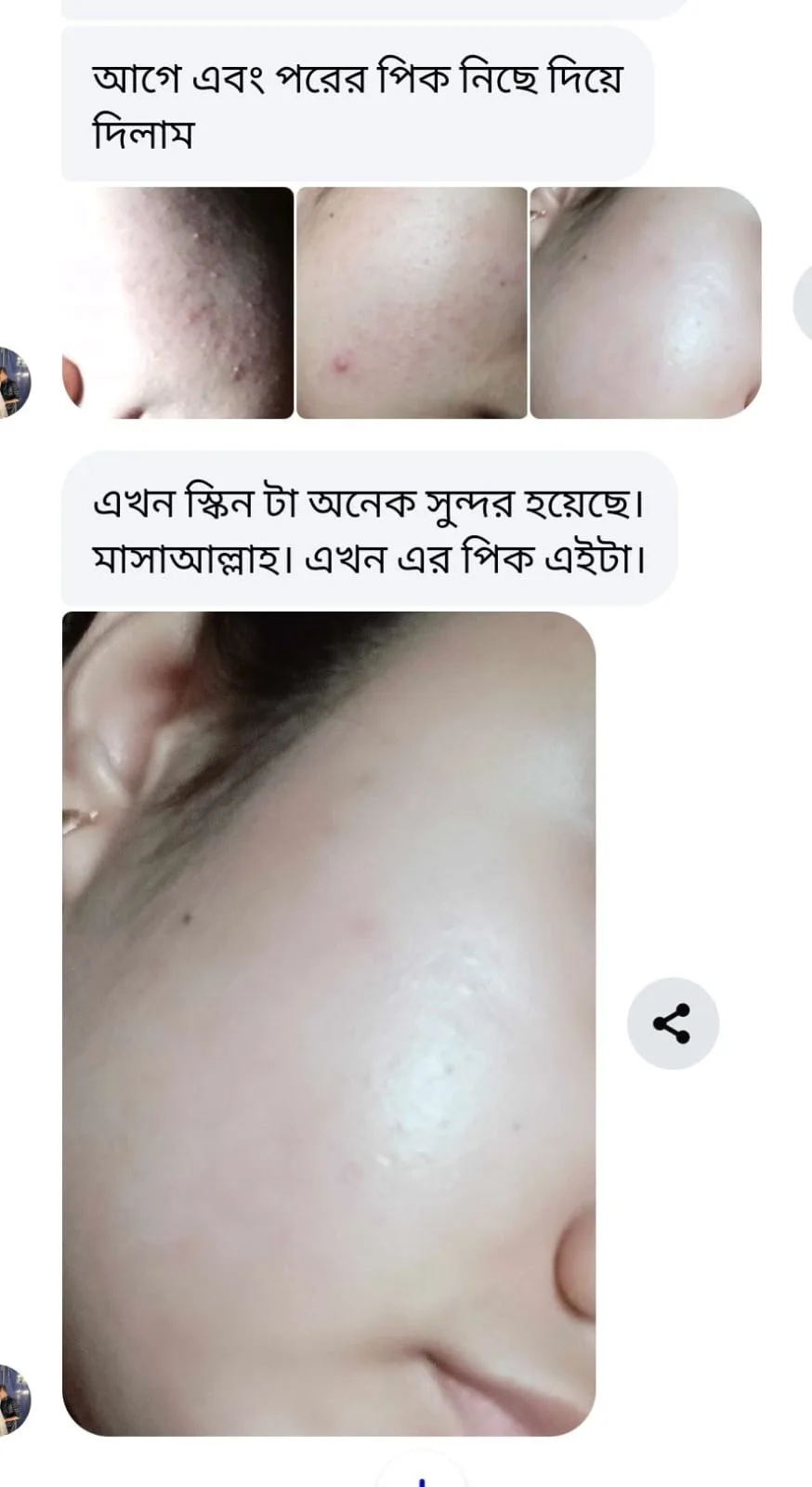 Acne & Pimple free skin